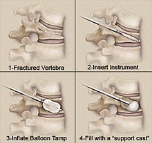 Vertebral