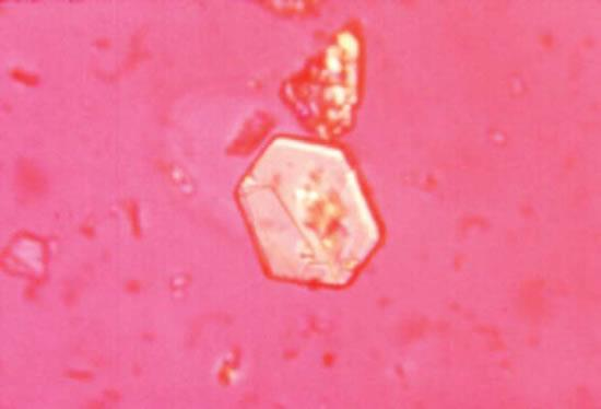 SİSTİN KRİSTALLERİ Hastaların idrarında sistin kristalleri bulunabilir Sistin kristalleri