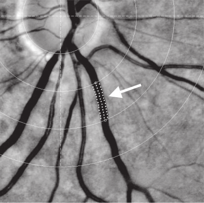09_245-250 (1773-1778) 7/9/09 3:06 AM Page 247 Şekil Optik diskin alt yarısını gösteren gri ölçek retinal fotoğraf ve çevre arteriyol ve venülde damar tracking ve genişlik ölçüm tekniği (beyaz ok)