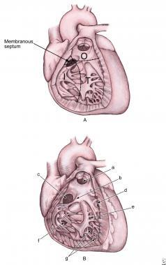 A: Image shows a ventricular septum viewed from the right side.