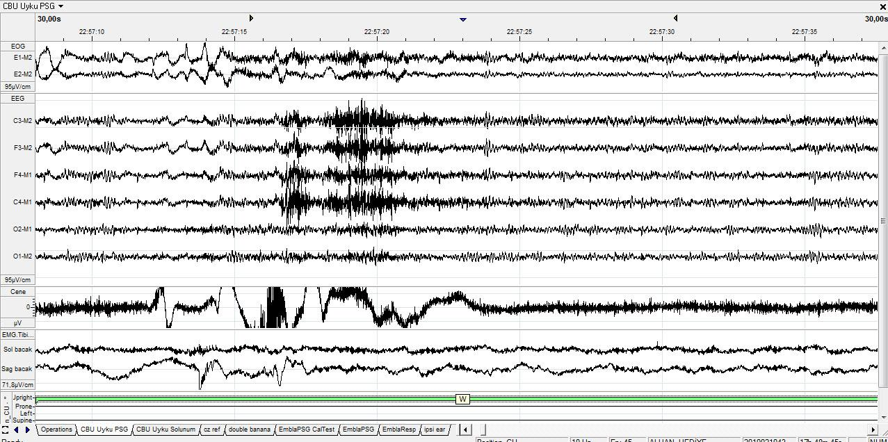 W Zemin aktivitesi 8-13 Hz pariyetooksipital alfa aktivitesinden oluşmuş, EOG de hızlı göz