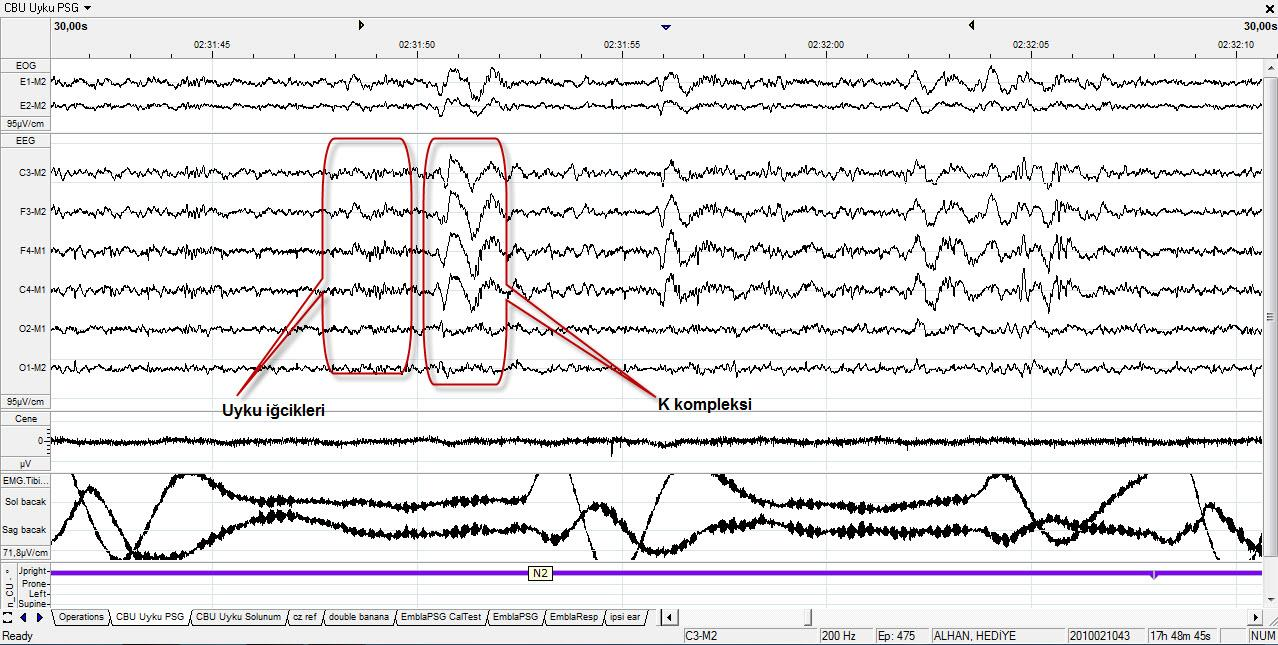 N2 K kompleksleri ve 13-14 Hz frekanslı uyku iğciklerinin varlığı