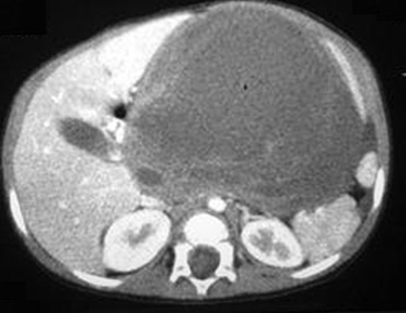 melidir (9). Çoğu infantil hemanjioendotelioma asemptomatiktir ve spontan involusyona uğrar, fakat çok azı ciddi komplikasyonlara yol açar. Çoğu ölüm konjenital hepatik fibrozise sekonderdir (10).