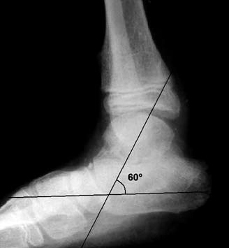 34 Acta Orthop Traumatol Turc (a) (b) (c) Şekil 1. (a) On bir yaşında spastik diplejik erkek hastanın yan ayak bileği grafisi.