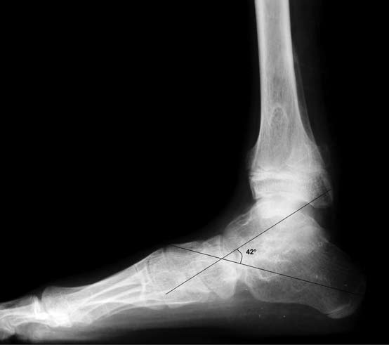 ayda basarak çekilmiş yan ayak bileği grafisinde talokalkaneal açı 42 ölçülen hastanın AOFAS ayak arkası skoru 85 idi. Tibiotalar ve midtarsal eklemlerde dejeneratif değişiklikler yoktu.