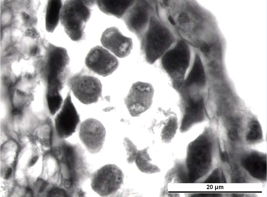 Şekil 4.15 Vitis vinifera L. cv. Uslu anterlerinde Telofaz- I de oluşan çekirdeklerin normal olmayan durumları Bar= 20 µm.