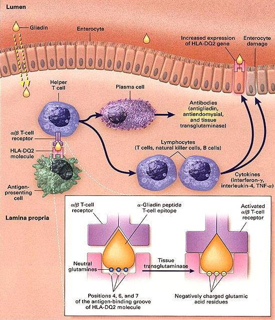 7 Şekil 2.2. Gluten sensitif enteropatinin patogenezi (Feldman:Sleisenger&Fordtran s Gastrointestinal And Liver disease, 8th ed.) 2.3.4.