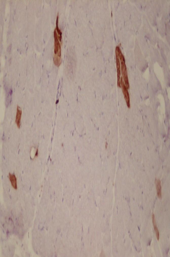 Atrofik angule fiberler, immatür patolojik fiber belirleyicisi