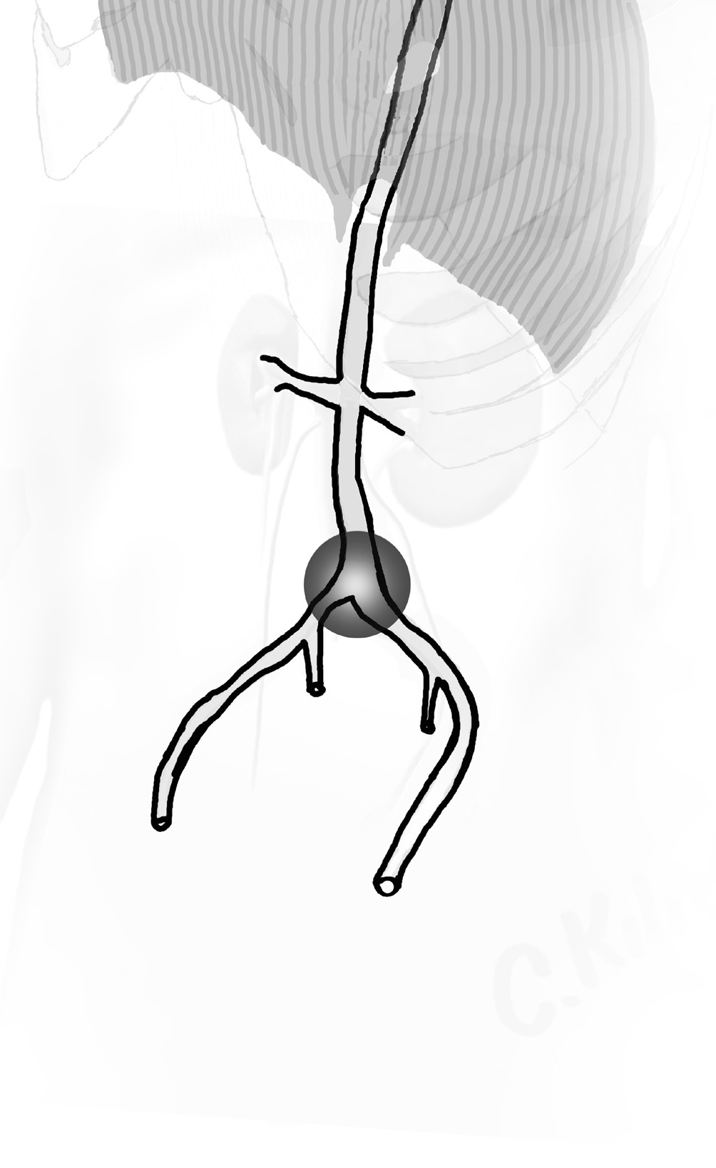 14 Bifurcatio aortae; pars abdominalis aortae nin L4 vertebra gövdesi üzerinde, iki uçdalına (a.