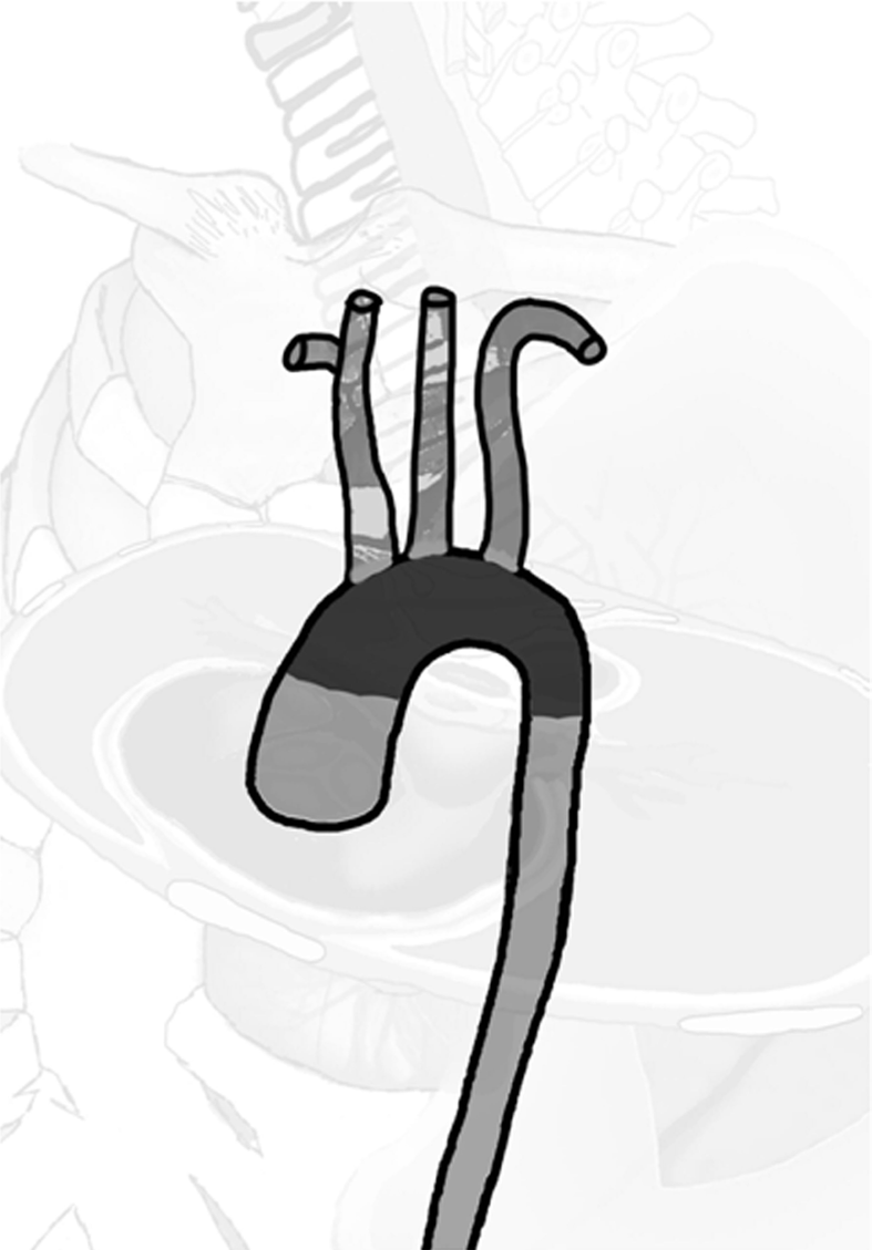 6 Arcus aortae; aorta ascendens in devamı olarak başlar ve açıklığı aşağıya bakan bir kavis çizerek, sol ikinci sternokostal eklemin arkasında (T4 alt kenarı) aorta descendens adını alarak aşağı
