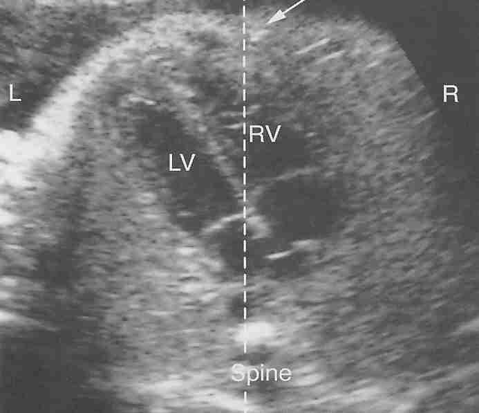 GÖRÜNÜMLER 4 boşluk görüntüsü-1 Fetal kalp taramasının en önemli görüntüsüdür.