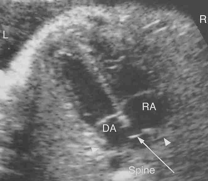 4 boşluk görüntüsü-3 - Foramen ovale atrial septumun 1/3 ünü oluşturur, flebi LA içindedir - Triküspit kapağın septal leafleti mitrale göre apexe