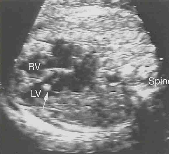 Sol ventrikül içinde ekojenik fokus görüntüsü % 1-3 - Çoğunlukla LV de(%93) - Kardiyak tümorden daha az ekojenik