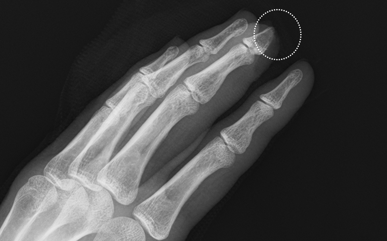 Adli Tıp Bu lteni Resim 2. Yan sol el grafisinde üçüncü parmak distal falanks orta kısımdan itibaren kemik defekti olduğu görülmektedir.