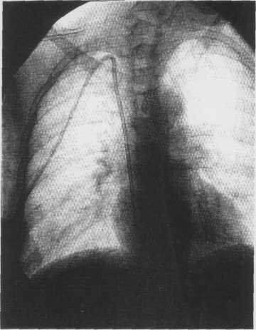 Shackleton CR, Taylor DC, Buckley AR, et al. Predicting failure in polytetrafluoroethylene vascular access grafts for hemodialysis: a pilot study. Can J Surg. 1987Nov;30(6):442-4. 4.