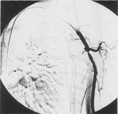 segment balonla dilate ediliyor.