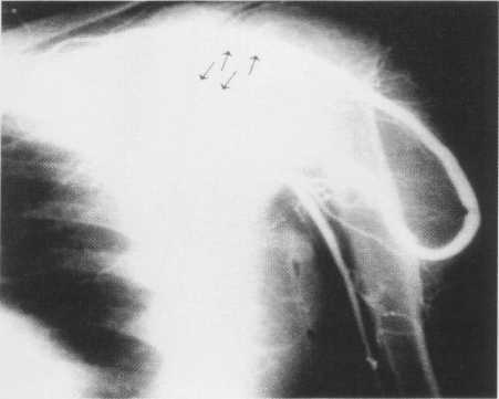 Resim 4 c: PTA ve stent implantasyonu sonrası, subklavyan ven %100 dilate