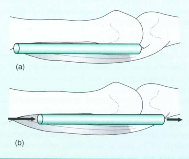 28 Şekil 2.4.2. Periferik sinirin longitudinal kayma kapasitesi Shacklock (70) dan alınmıştır. Şekil 2.4.3.