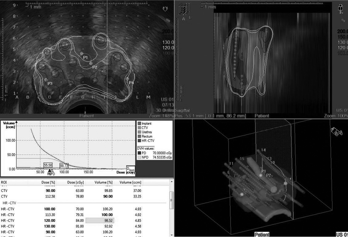 Bunun için prostat santralize edilmeli ve üretra santral hat üzerinde ve CTV nin alt sınırı kateter pozisyonunun en alt sınırının üzerinde olmalıdır.
