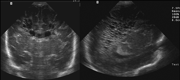 PRETERM: Hafif-Orta