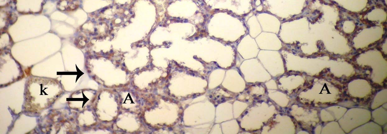immunreaksiyon gösteren alveol ve kanal epitel hücreleri (ok), X10 Östrojen Reseptörleri