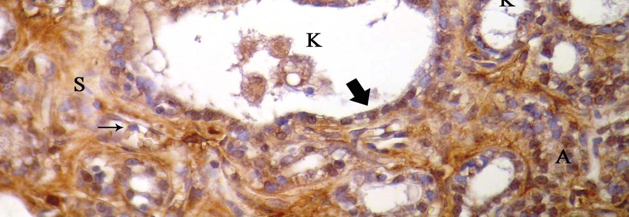 alveol, K: kanal, S: bağdoku, alveol ve kanal epiteli (kalın
