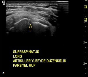 Journal Of Ankara University Faculty of Medicine 2015, 68 (2) Şekil 1: Ultrasonografi imajında (a) suprapinatus tendon distal kesimde tam kat yırtık ile uyumlu fokal hipoekoik alan (ok), aynı olgunun