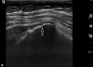 Şekil 2: Ultrasonografi imajında(a) suprapinatus tendon distal kesim artiküler yüzde parsiyel yırtık ile uyumlu düzensizlik(ok), Koronal plan PD TSE FS MR imajda (b) supraspinatus tendonu distal
