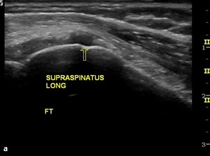 Ultrasonun supraspinatus tendinosis vakalarında duyarlılığı %82, özgüllüğü ise %93 tür (Tablo 2). Hem ultrasonografi hem de manyetik rezonans görüntüleme 6 vakayı normal bulmuştur.