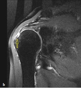 MR incelemede PD TSE sekansında belirgin hipointens sinyal özelliği ile supraspinatus tendonu yapışma düzeyinde kalsifik tendinit düşünülmüş, direk grafi ile tanı doğrulanmıştır.