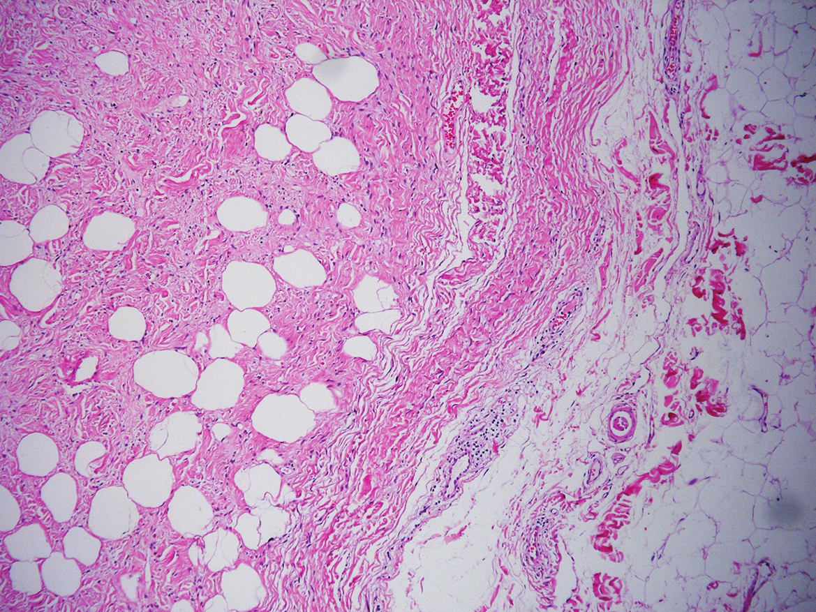İğsi Hücreli Lipomun Histolojik Özellikleri ve Ayırıcı Tanı Problemleri Şekil 1. Çevre dokulardan iyi bir sınırla ayrılmış, iğsi ve yağ hücresi içeren tümör alanı (H-E x 100).