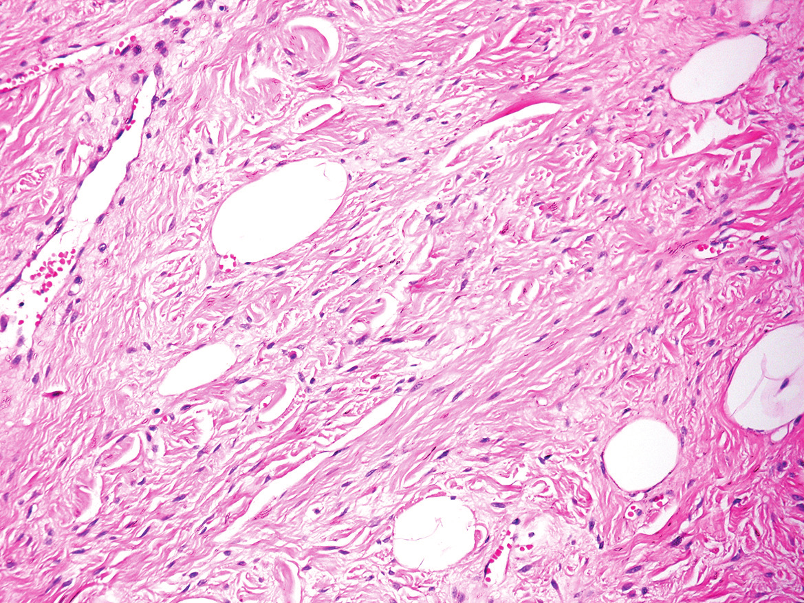 Miksoid, fibromatöz ve anjiyomatoid özellikler değişik oranlarda çoğu olguda karışık olarak izlendi. Lipoblast benzeri vakuollü hücreler ve mitoz hiçbir olguda mevcut değildi.