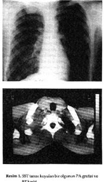 GKDC Dergisi 1998; 6: 71-78 SST thoracic inlet deki çeşitli anatomik yapıları invaze ederek diğer akciğer tümörlerinden daha farklı bir klinik tablo ile ortaya çıkar.
