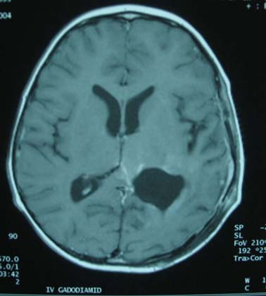 TARTIŞMA GBM, santral sinir sisteminin en sık görülen primer malign tümörüdür.