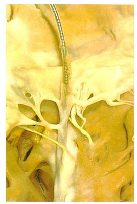 19 Şekil 2.5. Yakındaki triküspit kapakçıklara ve subvalvüler kordlara yapışık olan PM elektrodlarının yoğun fibröz doku ile kaplı olduğunu gösteren anatomik bir örnek.
