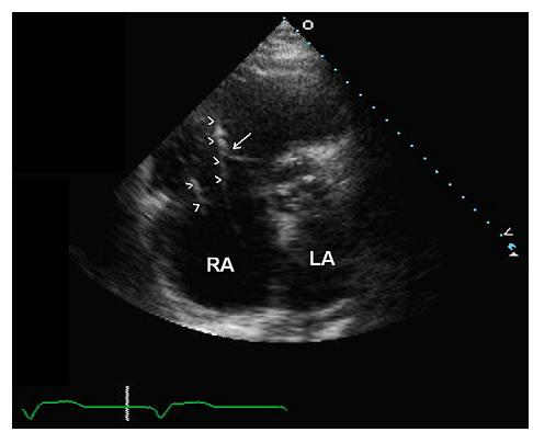 TK dan geçen 2 elekdrod var. LV,left ventricle; RV, right ventricle LA, left atrium.