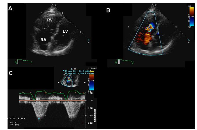 LA, Left atrium; LV, left ventricle; RA, right atrium, (American Society of Echocardiography, Maha A.Al-Mohaissen). Şekil 2.10.