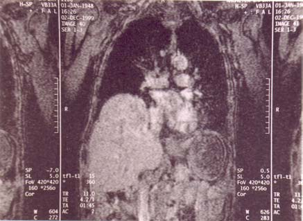 Cilt:31, Sayı:4, (29-33) Resim 3. BT Koronal ve sagittal MPR görüntülerde karaciğerin toraksa herniye olduğu ve defektte fokal sıkıştığı görülmektedir.