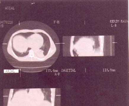 Resim 4. MR koronal T1 A G de sağda karaciğer üzerinde diafragma ya ait hipointens görünüm izlenememektedir. Sol da diyafragmada düzensizlik ve intensitede heterojenite görülmektedir.