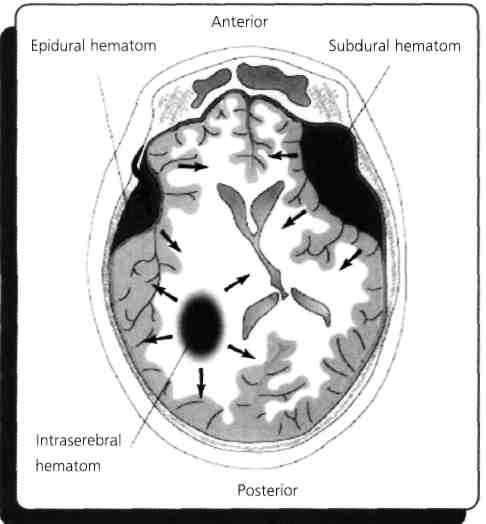 70) Arteria meninge media hangisinin dalıdır? (Eylül - 1997) A) A. cerebri media B) A. vertebralis C) A. carotis interna D) A. ophthalmica E) A.