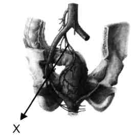 Pelvis arterlerini şematik olarak gösteren yukarıdaki şekilde "X" ile belirtilen arter aşağıdak-ilerden hangisidir? (Nisan - 2001) A) A. pudenda interna B) A. obturatoria C) A. sacralis mediana D) A.