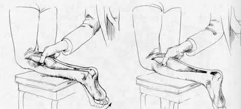 Aşil tendon rüptürü Parsiyel / komplet DF da aşırı eksentrik yüklenme neticesinde meydana