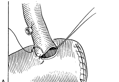 Resim 4- Bilioenterik anastomoz cerrahi teknik. Surgery of the Liver and Biliary Tract (3r