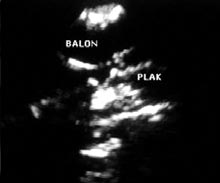 Taflo lu et al. Importance of transesophageal echocardiography for intraoperatively placed intraaortic balloon pump Tablo 2.
