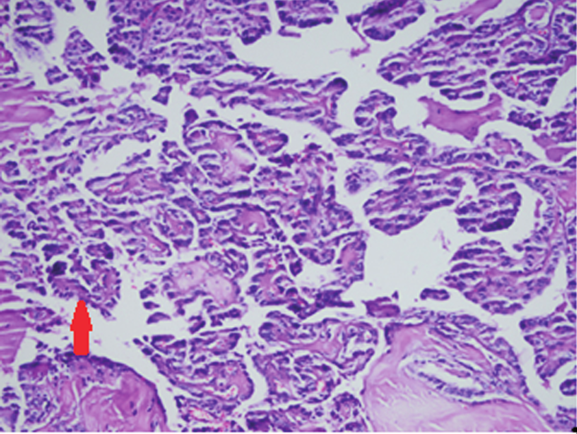 Tiroid sağ lobdaki İİAB si yetersiz sitolojik inceleme, sol servikal lenf nodundan yapılan İİAB si ise normal lenf nodu sitolojisi olarak raporlandı.