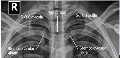 23: Stenoclavicular eklem anterior oblik