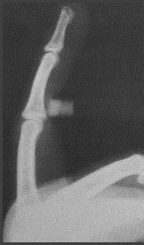 Yüzük Parmağı Lateral Radyografisinde Anatomik Yapı