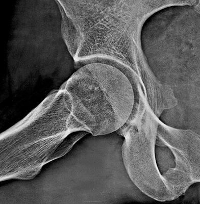 23: Kalça eklemi A-P radyogramı ve Ģeması (sol) Kalça Eklemi