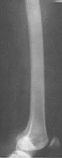 27: Femur A-P radyogramı (sağ) Femur Lateral 28: