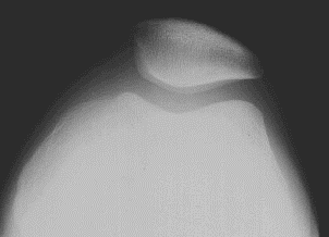 Diz Tanjansiyel Patellafemoral Eklem Radyografisinde Anatomik Yapı